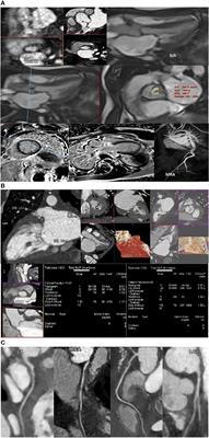 Pre-operative Considerations in Adult Mucopolysaccharidosis Patients Planned for Cardiac Intervention